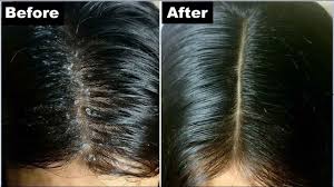 كيفية التخلص من قشرة الشعر نهائيا