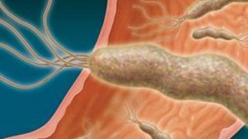 اهم أسباب الإصابة بجرثومة المعدة